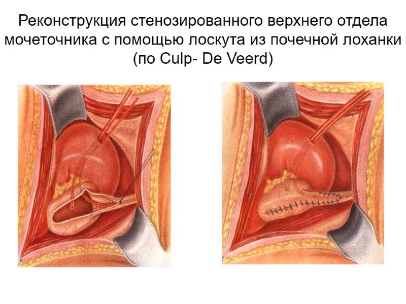 Реконструкция стенозированного верхнего отдела мочеточника с помощью лоскута из почечной лоханки  (по Culp-